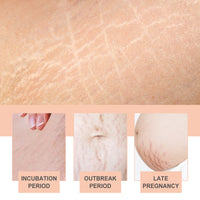 Snail Essence Pregnancy Stretch Mark Cream, Firming Skin Repair Lighten Postpartum Pregnancy Marks And Gestational Fat Smoothing Cream