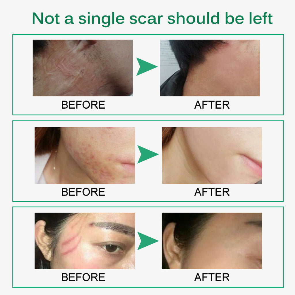 Scar & Stretch Mark Repair Cream