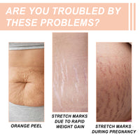 Snail Essence Pregnancy Stretch Mark Cream, Firming Skin Repair Lighten Postpartum Pregnancy Marks And Gestational Fat Smoothing Cream